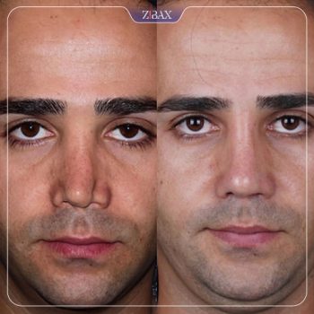 نمونه جراحی بینی با دکتر شاهین باستانی نژاد در تهران
