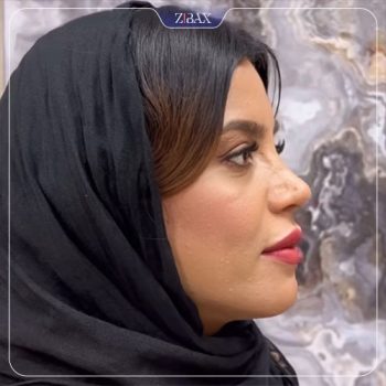 نمونه جراحی زیبایی بینی دکتر مهدی لبیبی