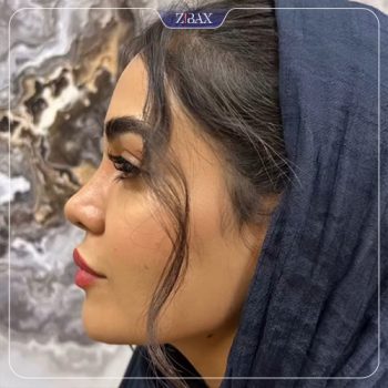 نمونه جراحی زیبایی بینی دکتر مهدی لبیبی
