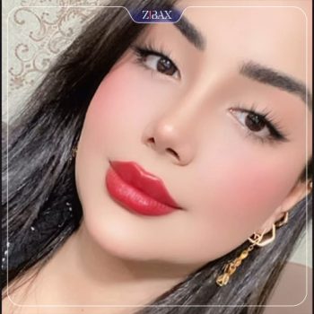 نمونه جراحی زیبایی بینی دکتر مهدی لبیبی