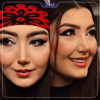 عکس عمل بینی با دکتر ماندانا فاوجی در تهران