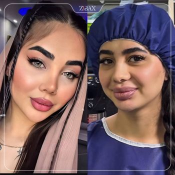 قبل و بعد عمل بینی با دکتر ماندانا فاوجی