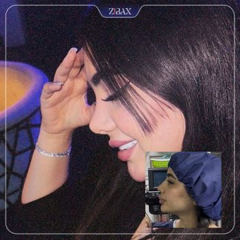 نمونه قبل و بعد عمل بینی با دکتر ماندانا فاوجی در تهران