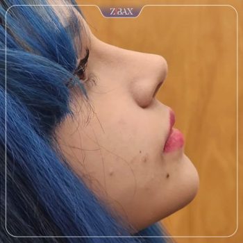 نمونه عمل زیبایی بینی دکتر یاسر نصوری