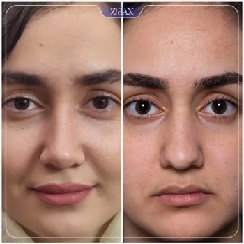نمونه عمل زیبایی بینی دکتر یاسر نصوری