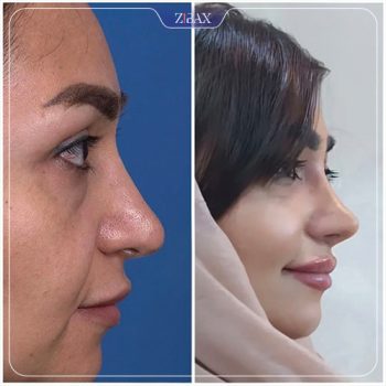 نمونه عمل زیبایی بینی دکتر یاسر نصوری