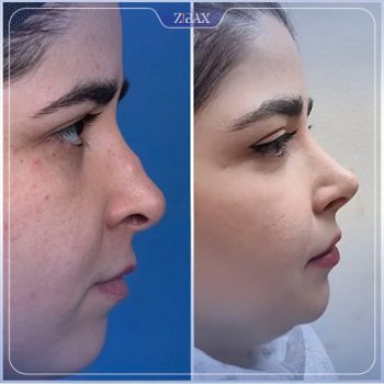 نمونه عمل زیبایی بینی دکتر یاسر نصوری