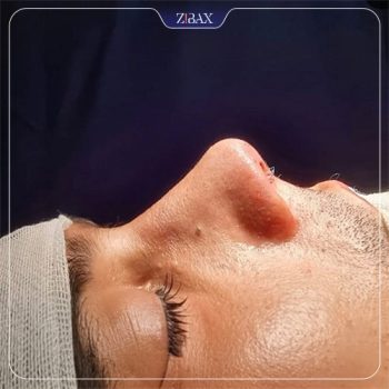 نمونه عمل زیبایی بینی دکتر یاسر نصوری