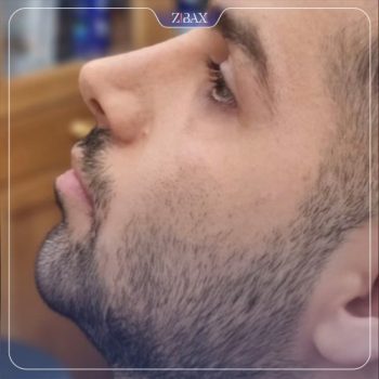 نمونه عمل زیبایی بینی دکتر یاسر نصوری