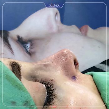 عکس قبل و بعد عمل بینی با دکتر رشته احمدی در شیراز