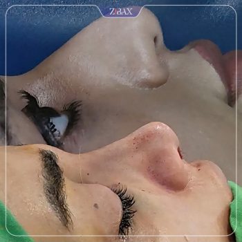 تصویر قبل و بعد عمل بینی با دکتر رشته احمدی در شیراز