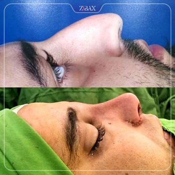 نمونه کار قبل و بعد عمل بینی با دکتر رشته احمدی در شیراز