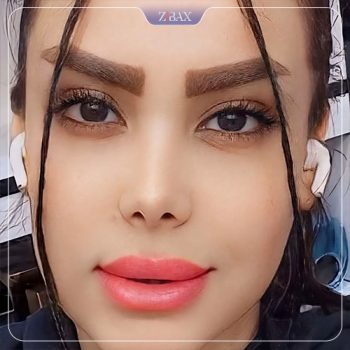 نمونه کار عمل زیبایی بینی دکتر کاظم رشته احمدی در شیراز