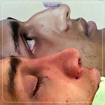 قبل و بعد عمل بینی توسط دکتر رشته احمدی شیراز