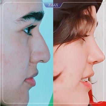 نمونه عمل بینی با دکتر غلامرضا کدخدایی جراح بینی شیراز