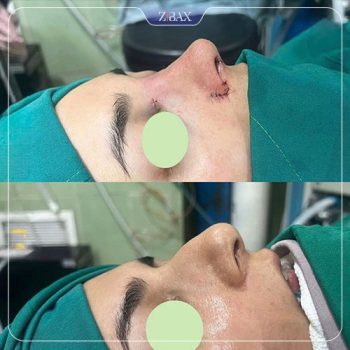 نمونه جراحی بینی با دکتر محمد اسماعیل کوشش در شیراز