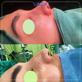 جراحی بینی توسط دکتر محمد اسماعیل کوشش در شیراز