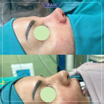 نمونه جراحی زیبایی بینی با دکتر محمد اسماعیل کوشش جراح بینی شیراز