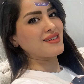 تصویر عمل زیبایی بینی با دکتر محمد اسماعیل کوشش در شیراز