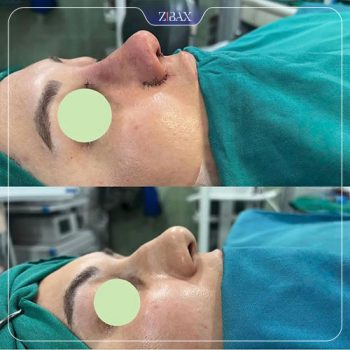 نمونه کار عمل زیبایی بینی دکتر محمد اسماعیل کوشش در شیراز