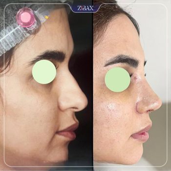 جراحی بینی با دکتر محمد اسماعیل کوشش در شیراز