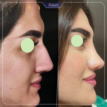 تصویر جراحی بینی توسط دکتر محمد اسماعیل کوشش در شیراز