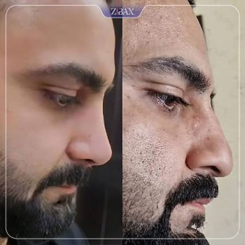 قبل و عمل عمل زیبایی بینی توسط دکتر عین آبادی در شیراز