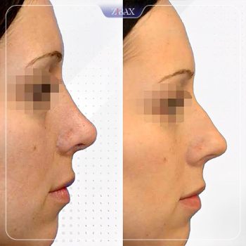 نمونه جراحی بینی توسط دکتر وحید عین آبادی در شیراز