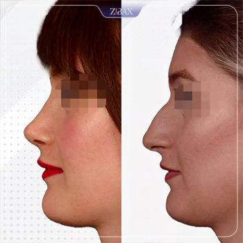 قبل و بعد عمل بینی توسط دکتر عین آبادی در شیراز