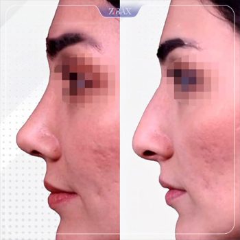 عکس نمونه کار دکتر عین آبادی عمل بینی