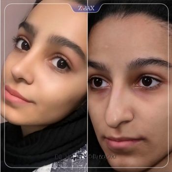 نمونه جراحی بینی با دکتر مجتبی ملکی در تهران