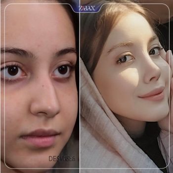 جراحی بینی با دکتر مجتبی ملکی در تهران