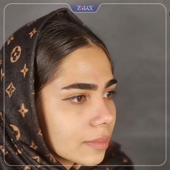 نمونه جراحی بینی دکتر محمد صفری کمال آبادی