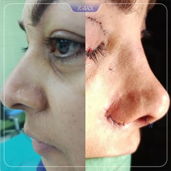 نمونه جراحی بینی با دکتر محمد مهدی مهرابی