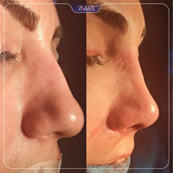 نمونه جراحی بینی با دکتر محمد مهدی مهرابی