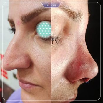 نمونه جراحی بینی با دکتر محمد مهدی مهرابی