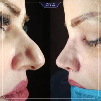 نمونه جراحی بینی با دکتر محمد مهدی مهرابی