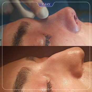 نمونه جراحی بینی با دکتر محمد مهدی مهرابی