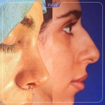 نمونه جراحی بینی با دکتر محمد مهدی مهرابی