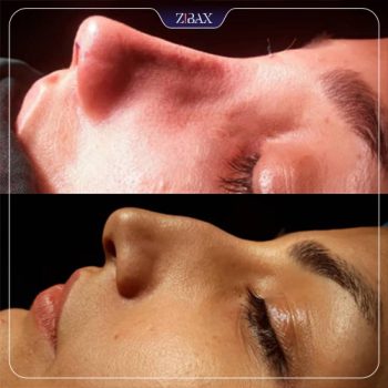 نمونه جراحی بینی با دکتر محمد مهدی مهرابی