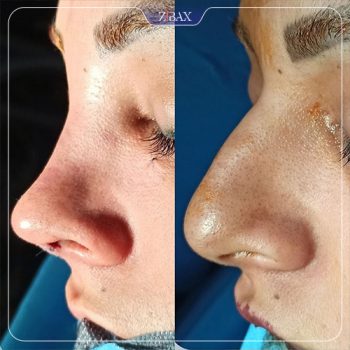 نمونه جراحی بینی با دکتر محمد مهدی مهرابی