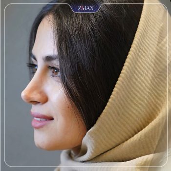 نمونه جراحی بینی با دکتر اسدالله مهدوی در تهران