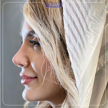 عکس جراحی زیبایی بینی توسط دکتر اسدالله مهدوی در تهران
