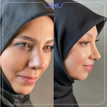 تصویر جراحی بینی توسط دکتر اسدالله مهدوی در تهران