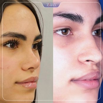 نمونه جراحی بینی دکتر نصیر سعیدی در شیراز