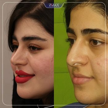 نمونه عمل بینی دکتر نصیر سعیدی در شیراز