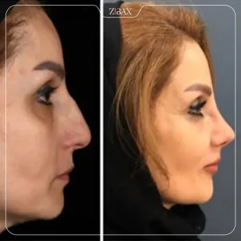 نمونه جراحی بینی دکتر مرتضی نوری