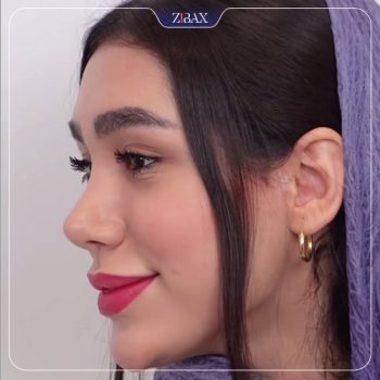 نمونه کار جراحی بینی دکتر 1حتمد پوستچی