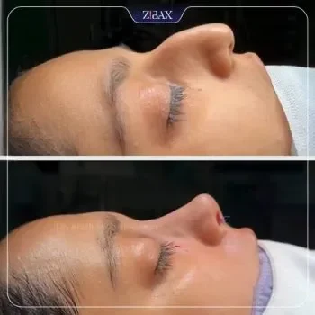 جراحی بینی نیمه فانتزی دکتر آرش سبحان منش شیراز