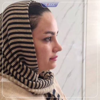 نمونه کار جراحی بینی دکتر آزاده مرادی